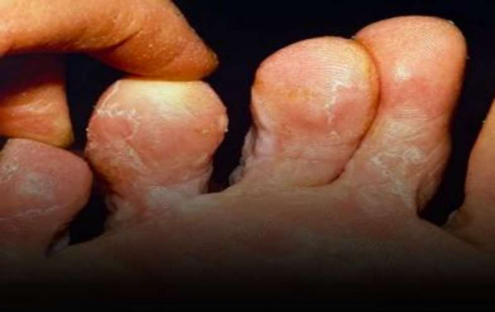 Cuida tus pies. Todo sobre los hongos y cómo prevenirlos