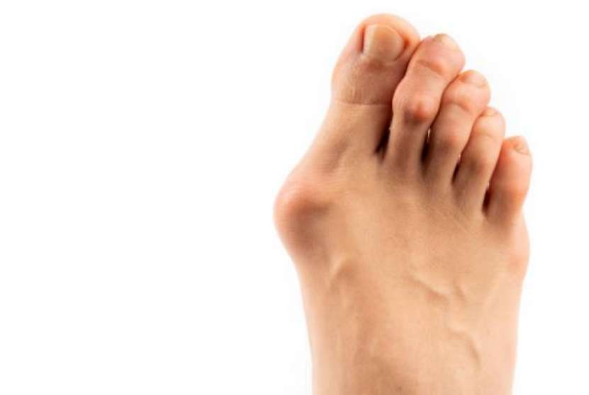 Juanete (Hallux Valgus): ¿qué es, por qué aparece?