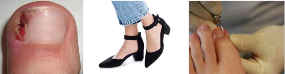 Uñas encarnadas en los pies: qué son, por qué ocurren y cómo prevenirlas