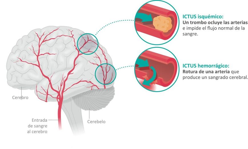 01ictus