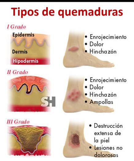quemaduras03