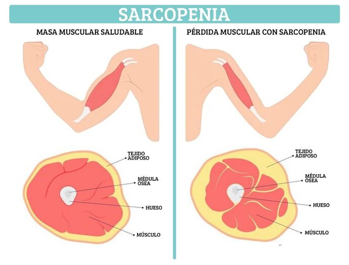 sarcopenia03